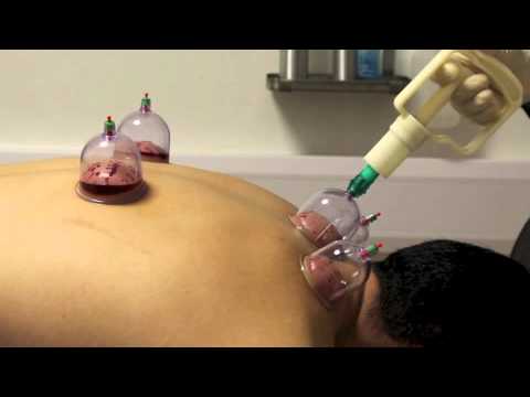 Performing Hijama (Wet Cupping) at Cardiff Hijama Center UK - Testimonial By Mustafa!